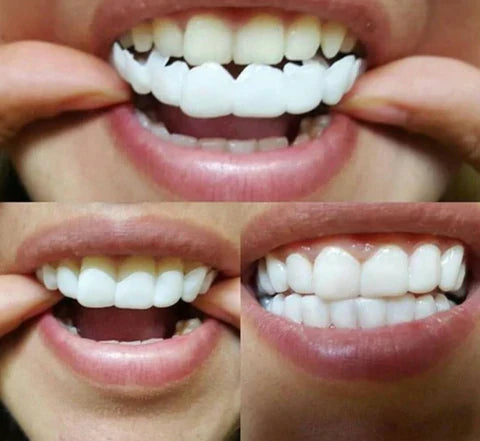 Facettes dentaires artificielles